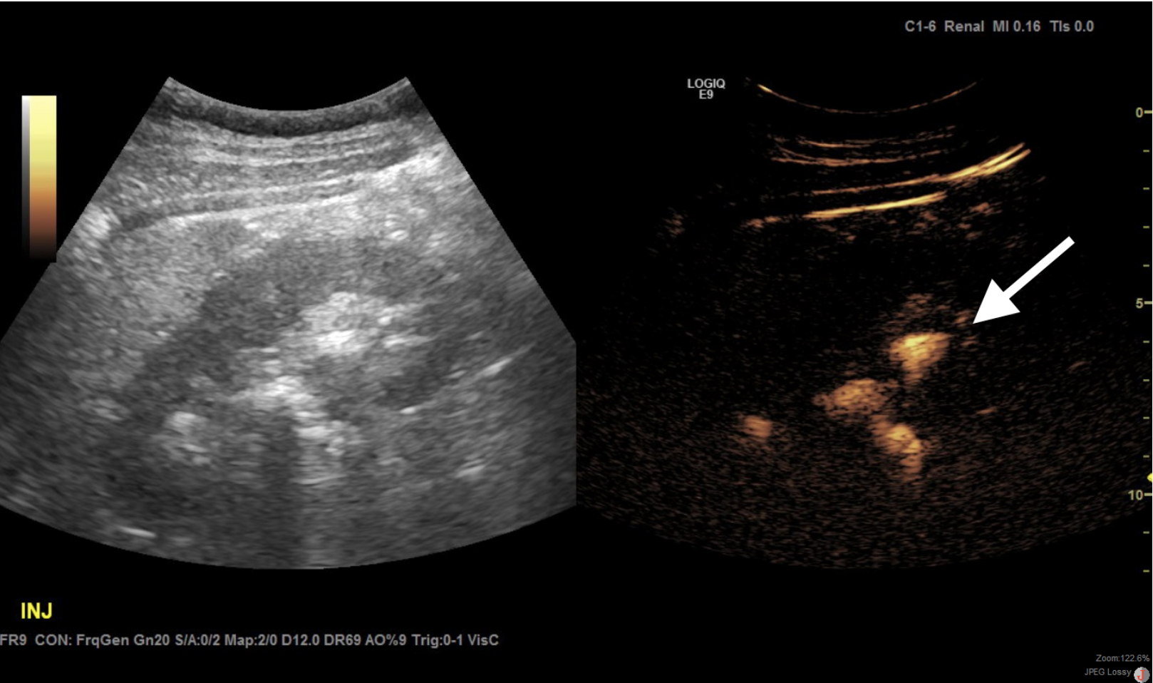 Contrast-enhanced Ultrasound: Better Visualization With Zero Radiation ...